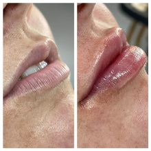 Load image into Gallery viewer, Lip Filler