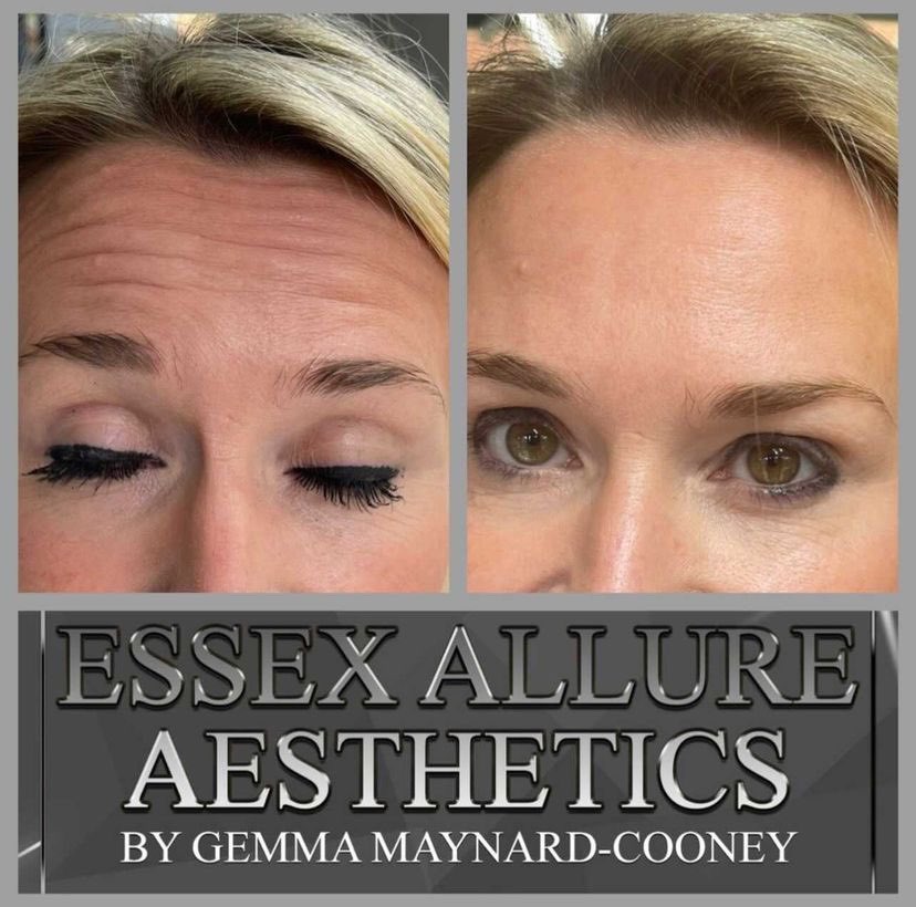 Anti Wrinkle Injections