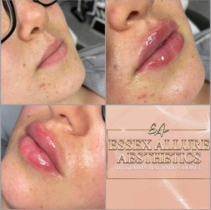 Lip Filler