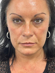 Cheek Filler