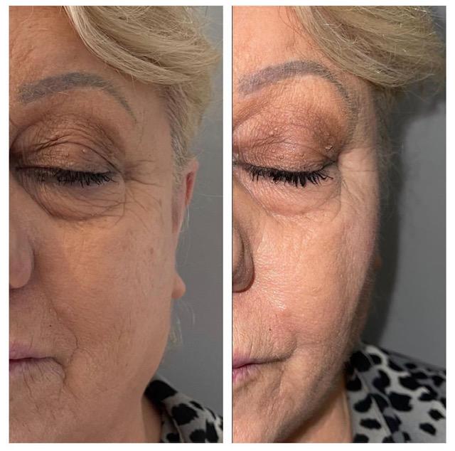 Cheek Filler