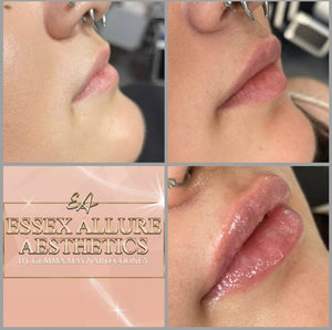 Lip Filler