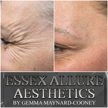 Load image into Gallery viewer, Anti Wrinkle Injections
