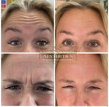 Load image into Gallery viewer, Anti Wrinkle Injections
