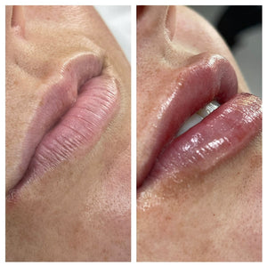 Lip Filler